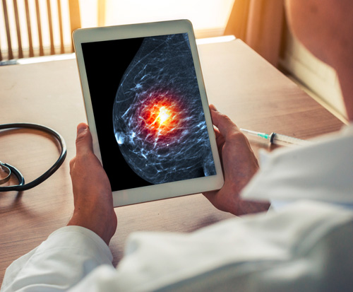 Inteligencia artificial para diagnosticar el cáncer de mama